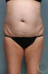 Liposuction Case 4 Before